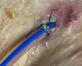 Image of human hand with Chinese finger trap shown on index finger