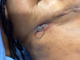 Image of K-LOCK™ with braid and surgical drain retained in rotating arm holder