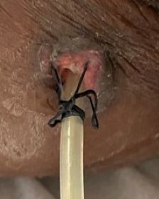 Image of K-LOCK™ with braid and surgical drain retained in rotating arm holder