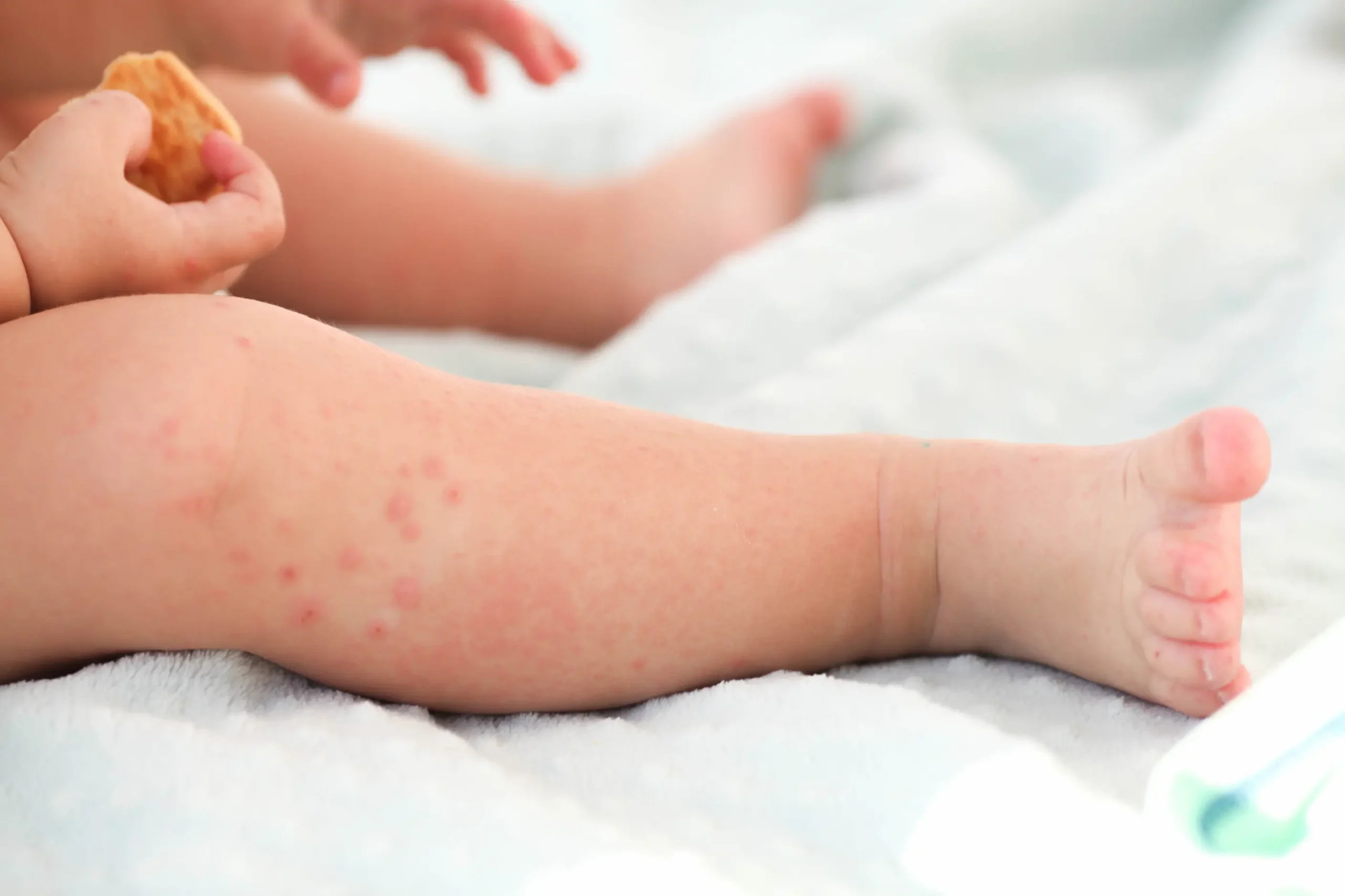 La varicelle chez l’enfant : comment le protéger et le soulager
