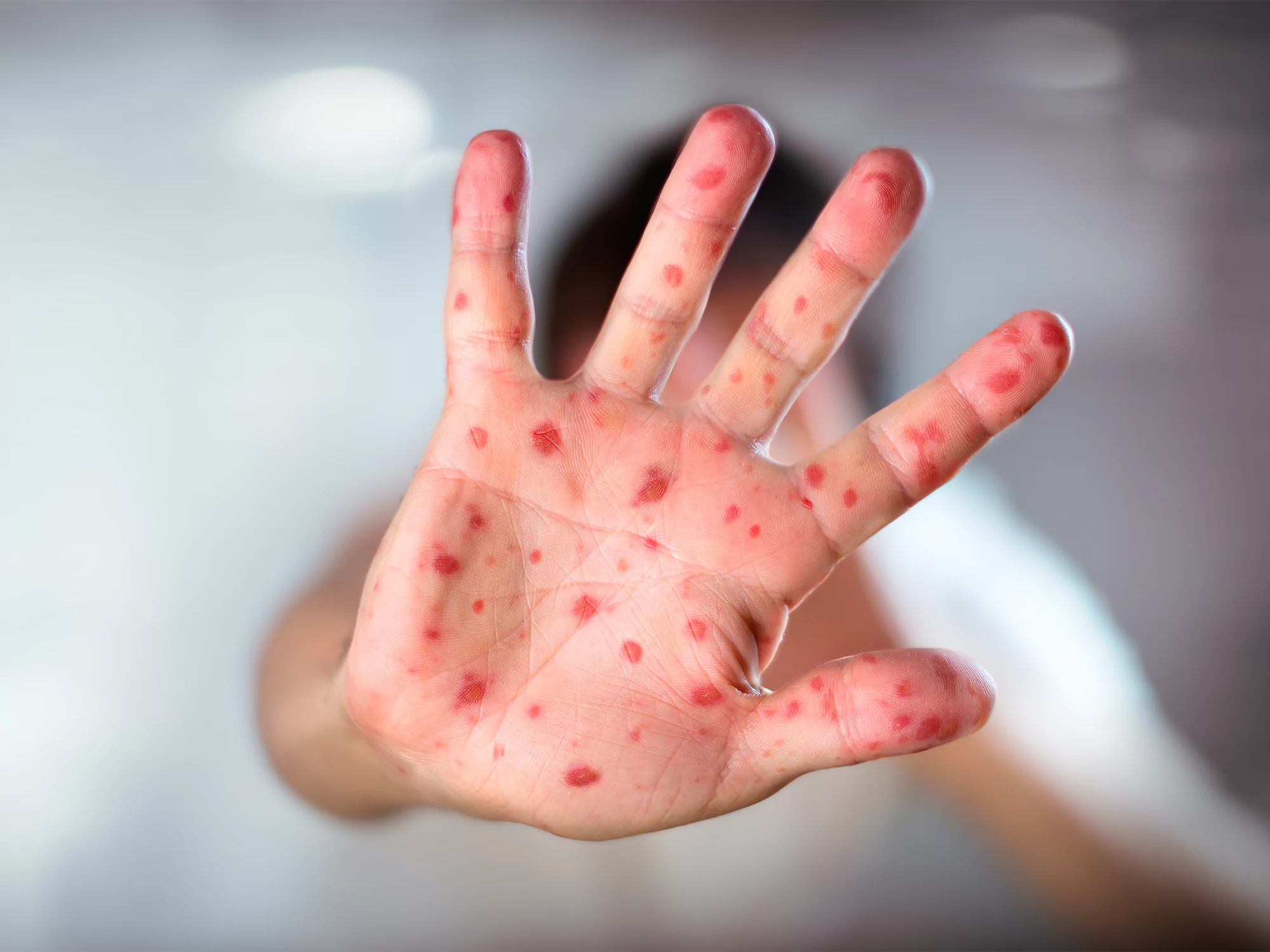 Rougeole : ce qu’il faut savoir face au retour de certains virus 