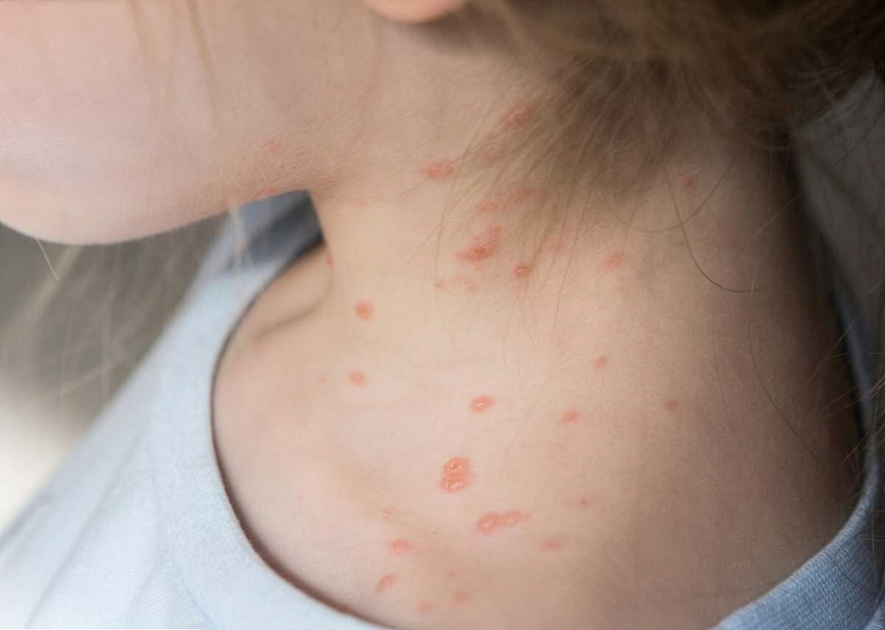 Varicelle : la reconnaître, soulager les symptômes et savoir quand consulter