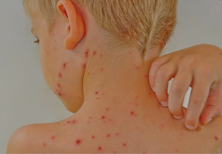 Varicelle : la reconnaître, soulager les symptômes et savoir quand consulter