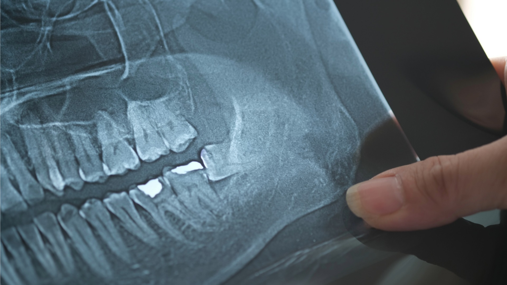 An xray of wisdom teeth