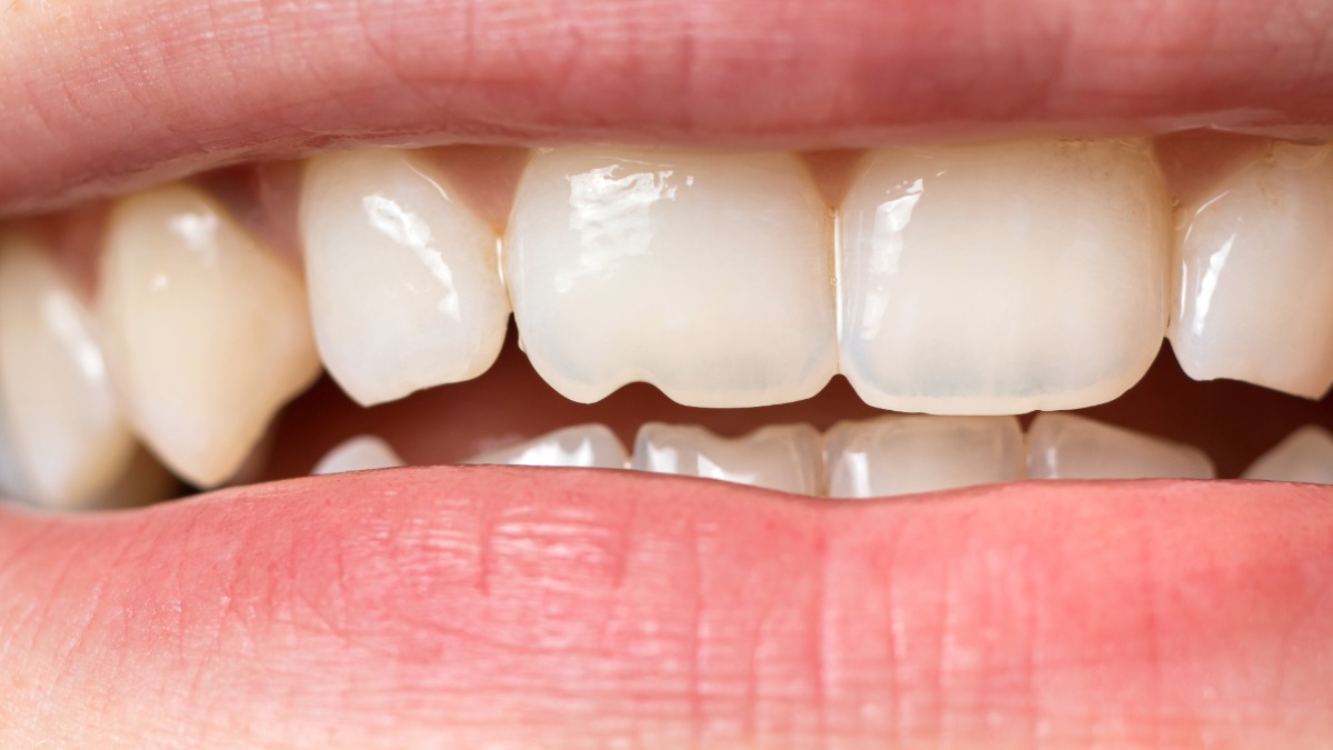 A close up photo of a mouth with a chipped front tooth
