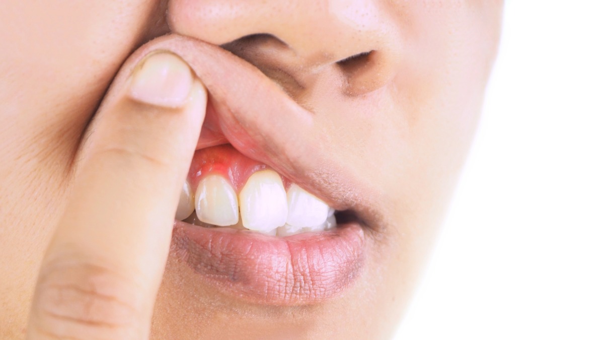 A closeup of inflamed gums