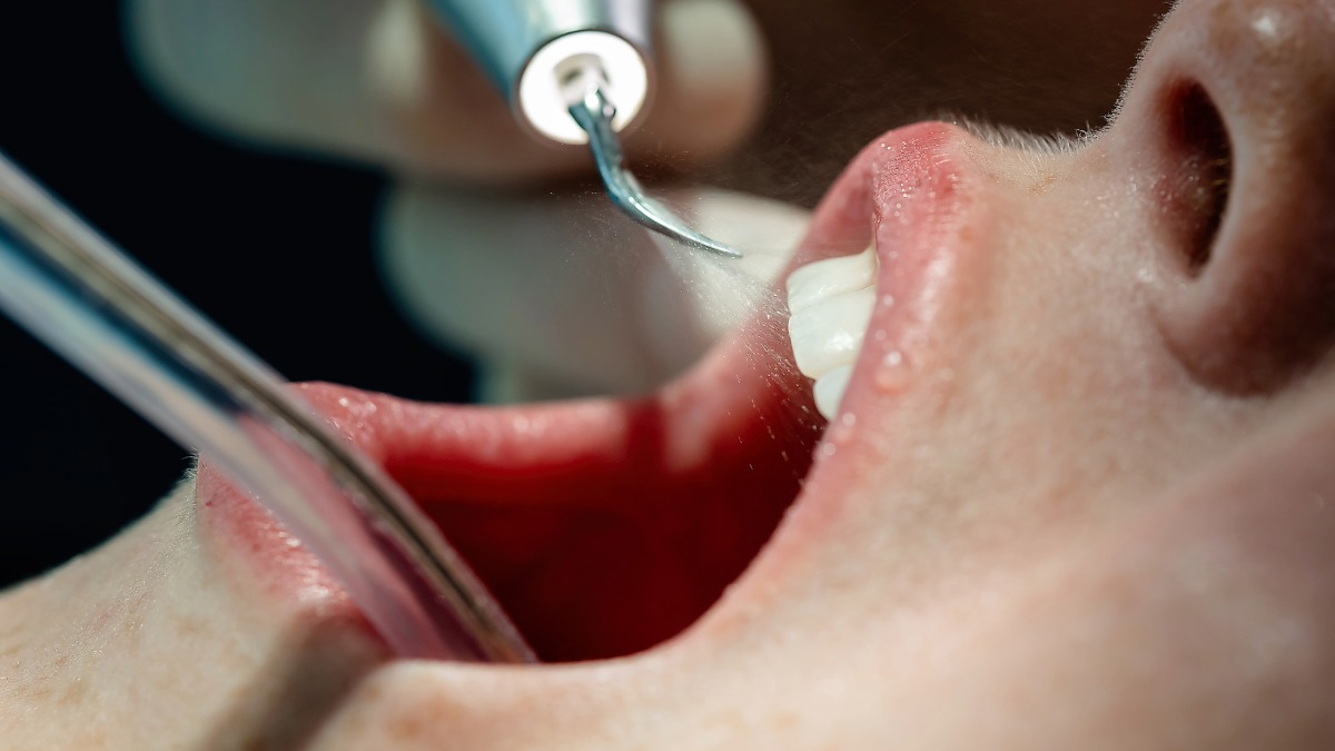 A closeup of someone's mouth being rinsed during a dental cleaning