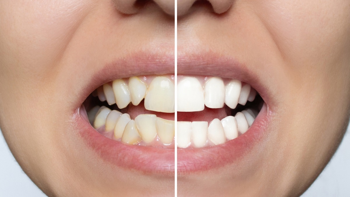 A before and after comparison of whitened teeth