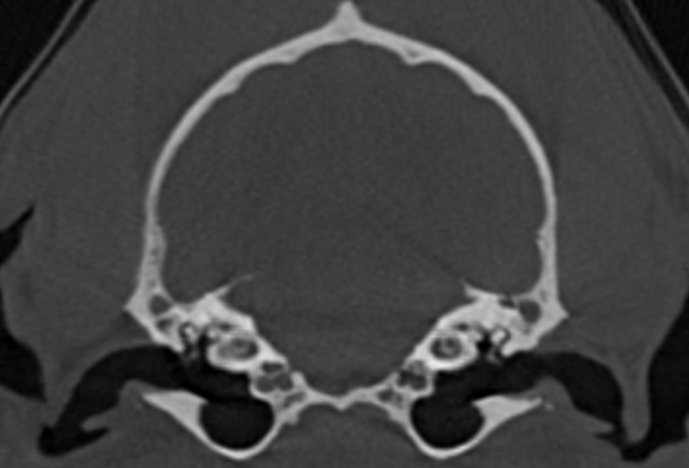 Coronale CT-Aufnahme des menschlichen Schädels zeigt die Innenstruktur der Gehörgänge und Knochen.