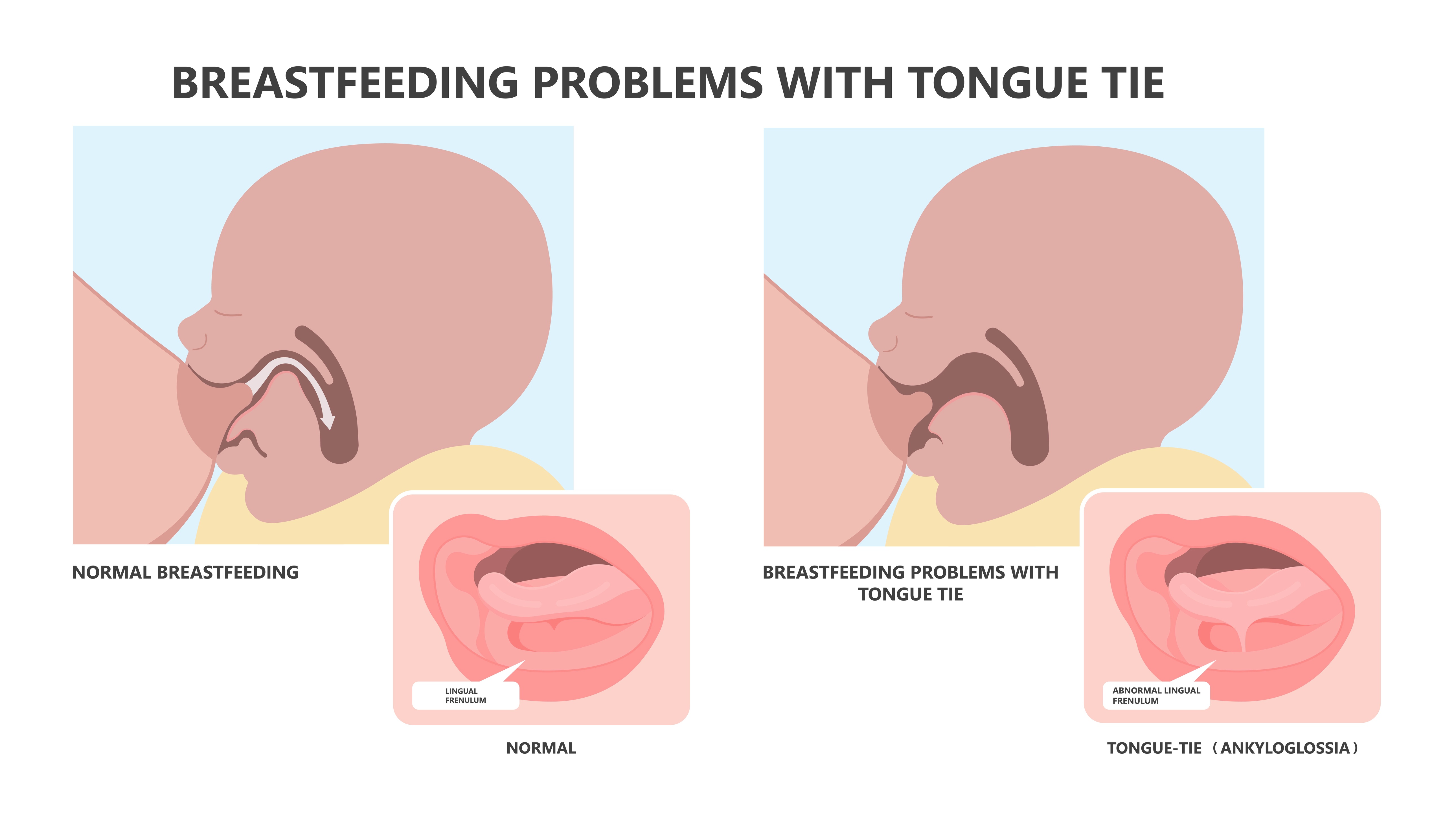 Breastfeeding problems with tongue tie