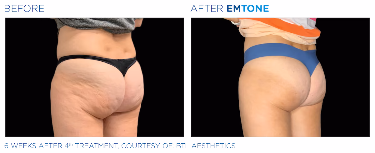 Before and After photos of Emtone treatment at SculptAZ Med Spa.