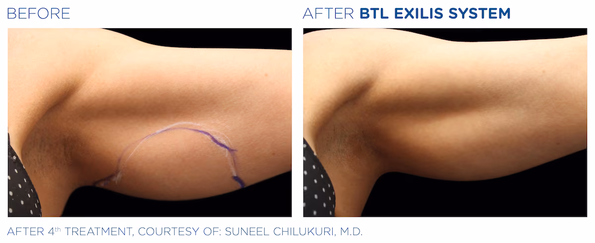 Before and After photos of BTL Exilis System treatment at SculptAZ Med Spa.