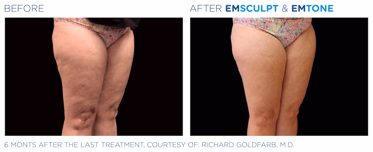 Before and After photos of Emsculpt Neo and Emtone treatment at SculptAZ Med Spa.