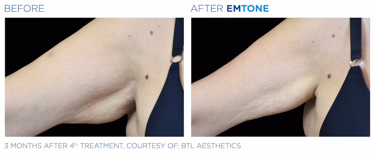Before and After photos of Emtone treatment at SculptAZ Med Spa.