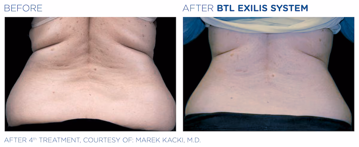 Before and After photos of BTL Exilis System treatment at SculptAZ Med Spa.