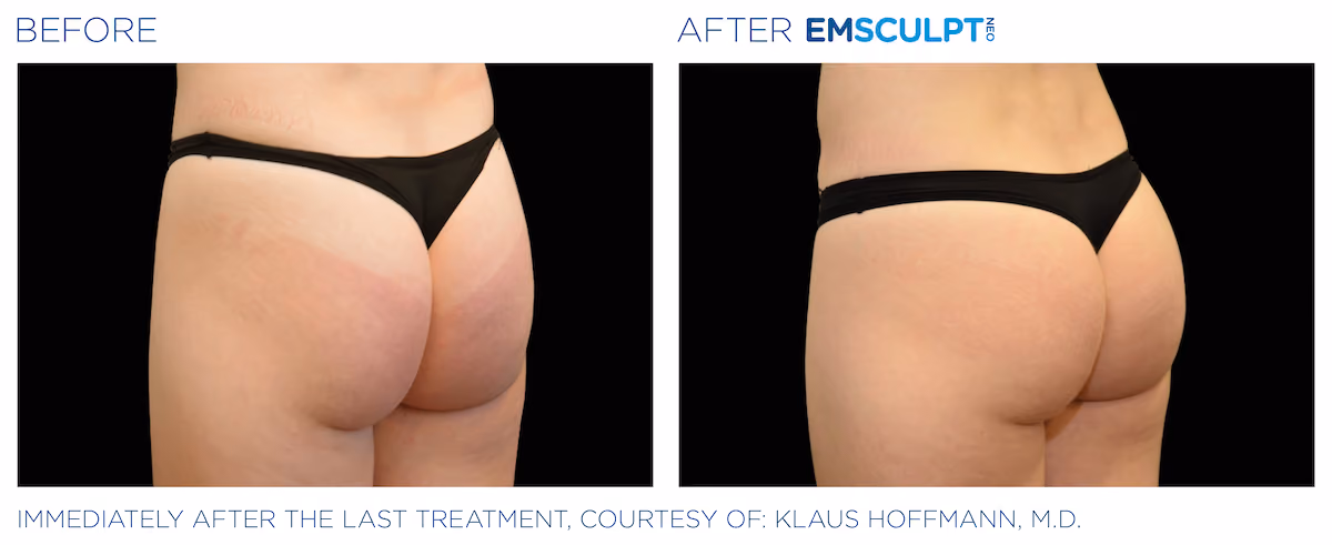 Before and After photos of Emsculpt Neo treatment at SculptAZ Med Spa.