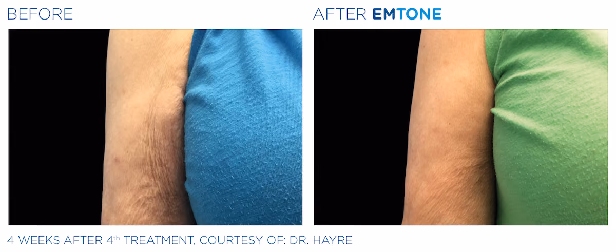 Before and After photos of Emtone treatment at SculptAZ Med Spa.