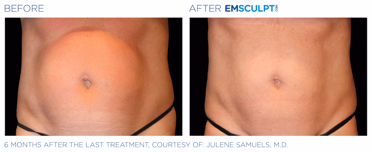 Before and After photos of Emsculpt Neo treatment at SculptAZ Med Spa.