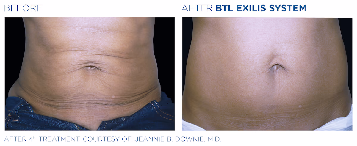 Before and After photos of BTL Exilis System treatment at SculptAZ Med Spa.