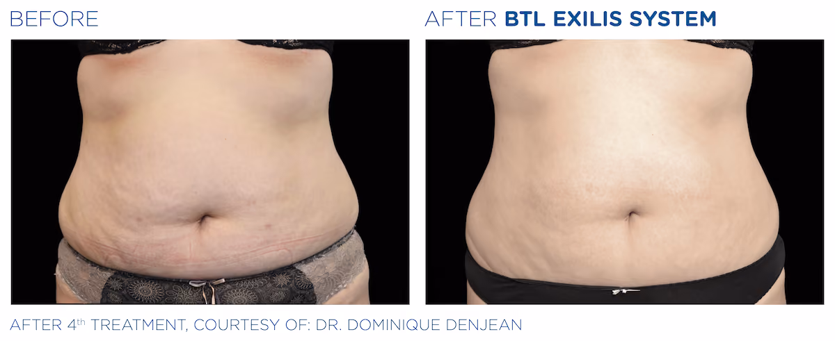 Before and After photos of BTL Exilis System treatment at SculptAZ Med Spa.