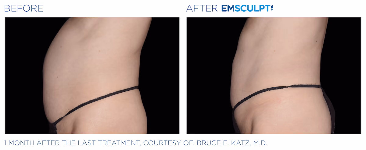 Before and After photos of Emsculpt Neo treatment at SculptAZ Med Spa.