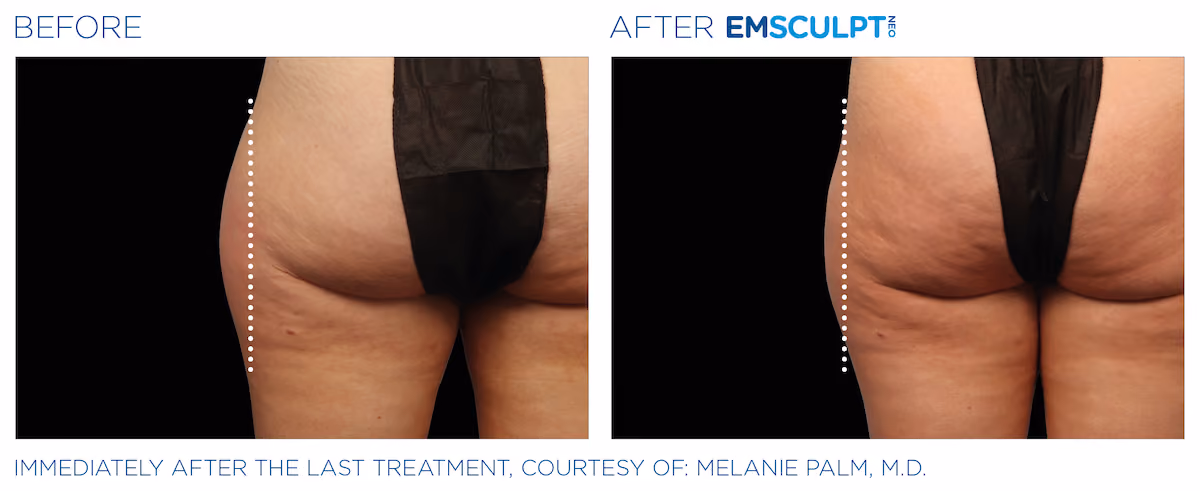 Before and After photos of Emsculpt Neo treatment at SculptAZ Med Spa.