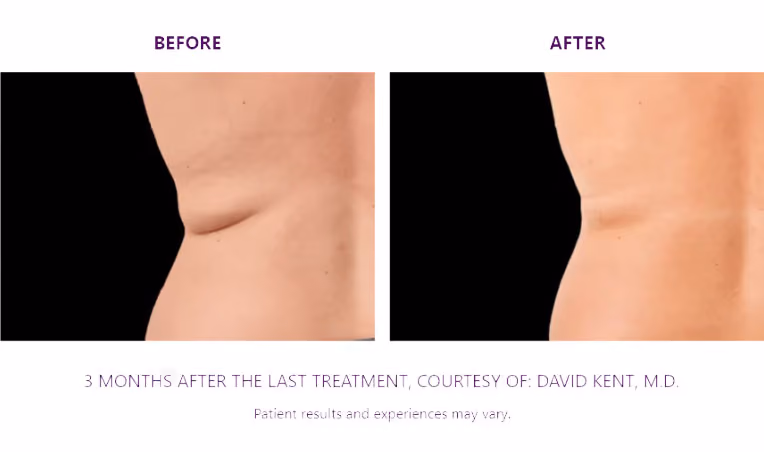 BTL Exion Treatment