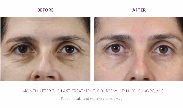 BTL Exion Treatment