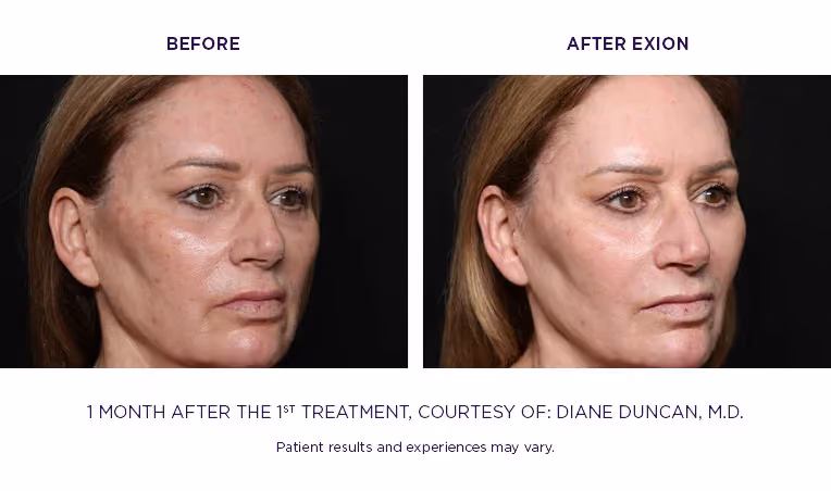 BTL Exion Treatment
