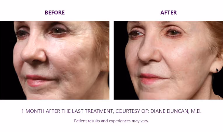 BTL Exion Treatment