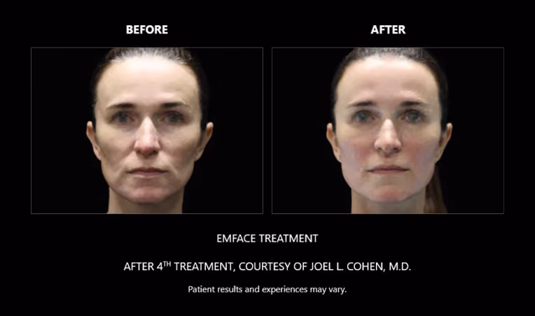 BTL Exion Treatment