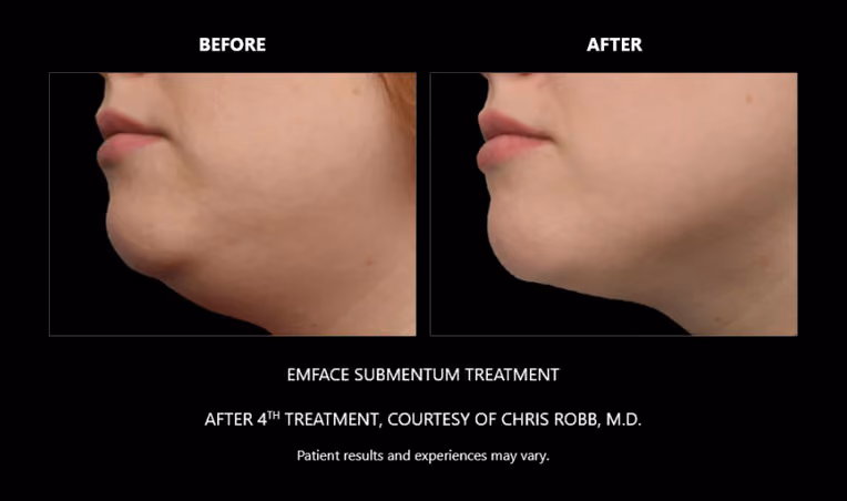 BTL Exion Treatment