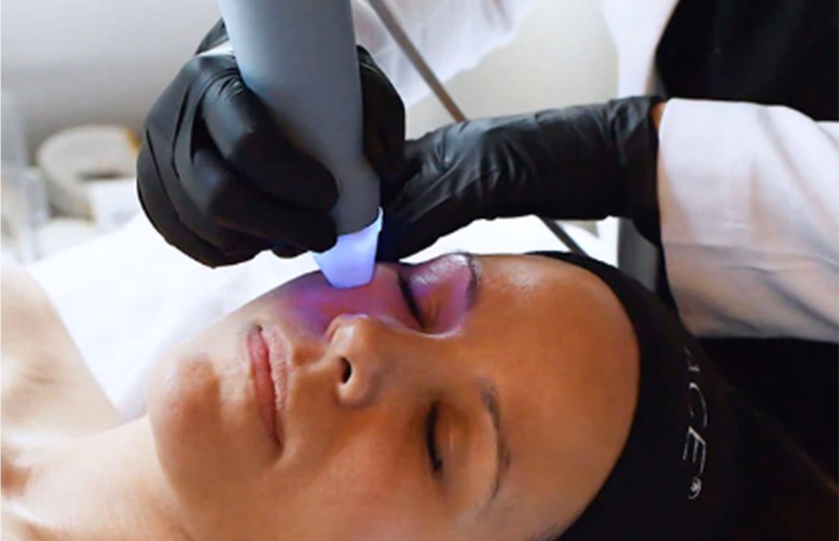 Exilis vs. Exion: Which Skin Tightening Treatment Is Right for You?
