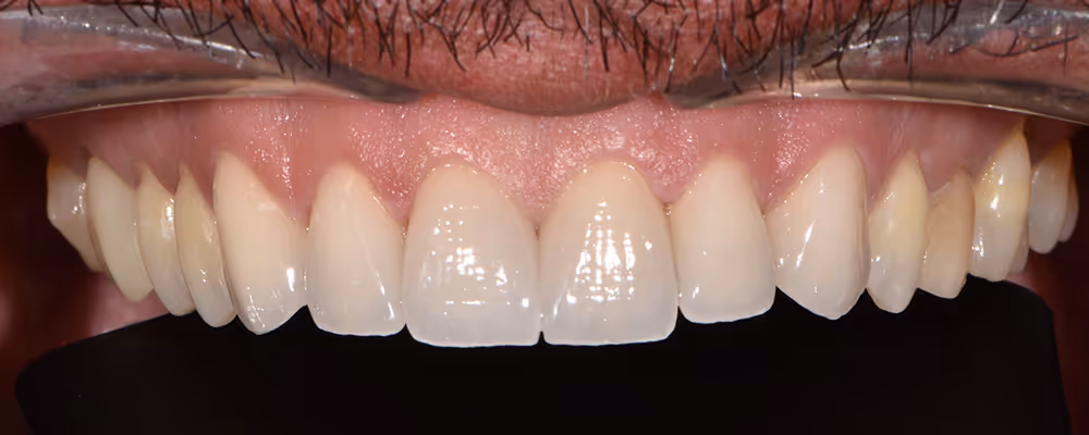 Patient's teeth after treatment