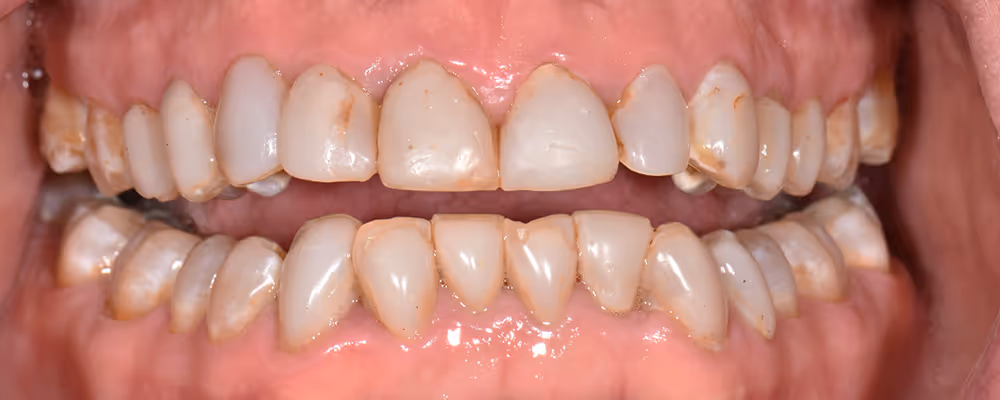 Patient's teeth before Smile Makeover treatment