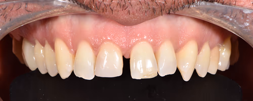 Patient's teeth before treatment
