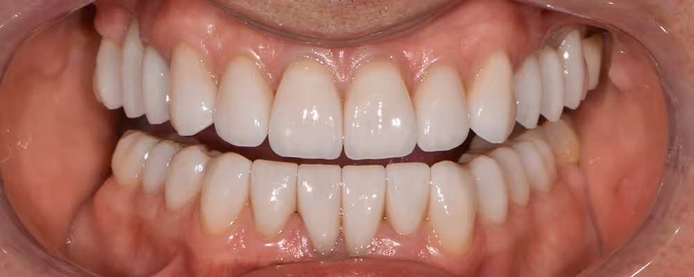 Patient's teeth after treatment