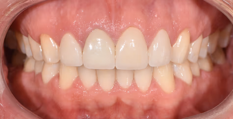Patient's teeth after Smile Makeover treatment