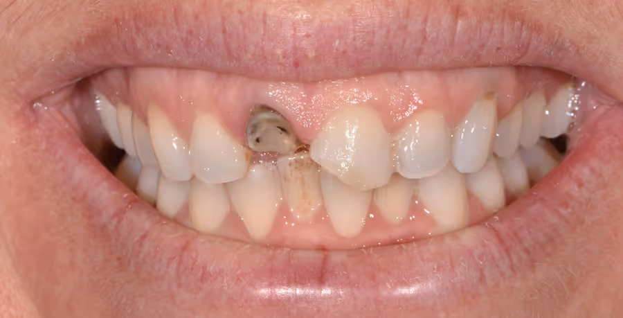 Patient's teeth before Smile Makeover treatment