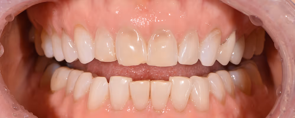 Patient's teeth before Smile Makeover procedure at Miami Beach Smiles.