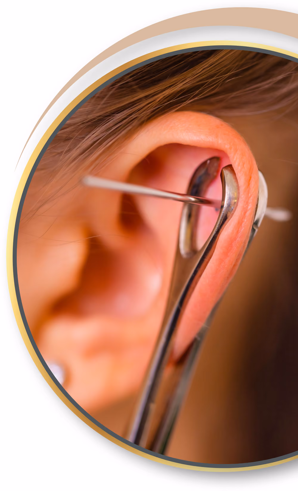 Akupunktur Piercing von Nadelkust für Eupen 