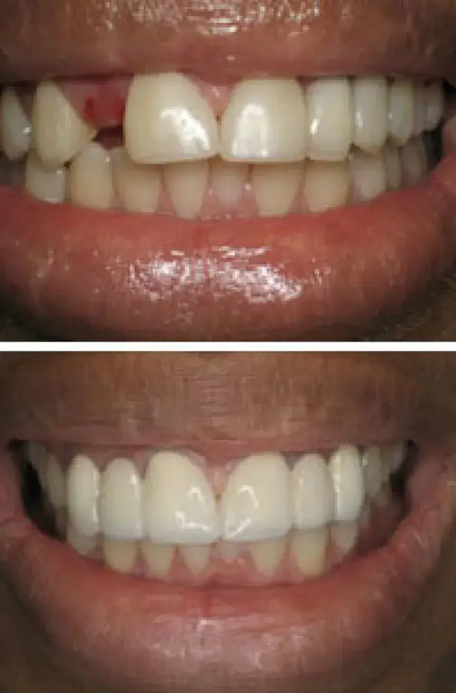 Missing tooth repair in Hayward, California