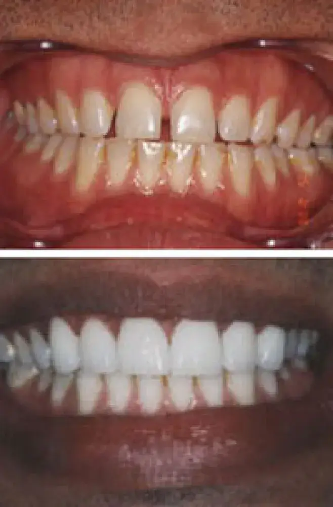 Teeth Whitening in Hayward, California
