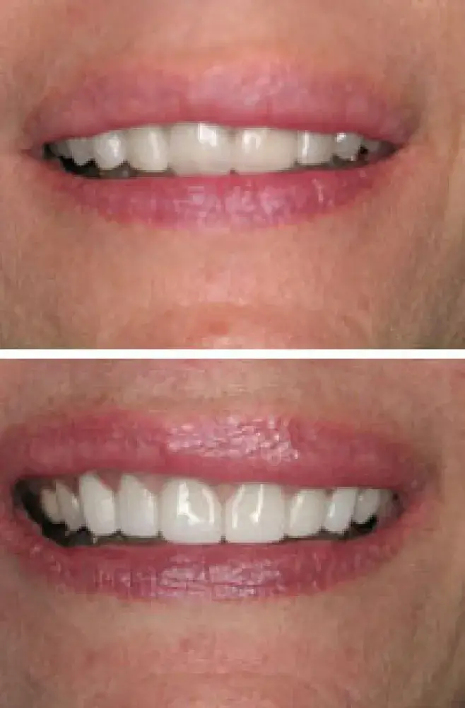 White Teeth in Hayward, California