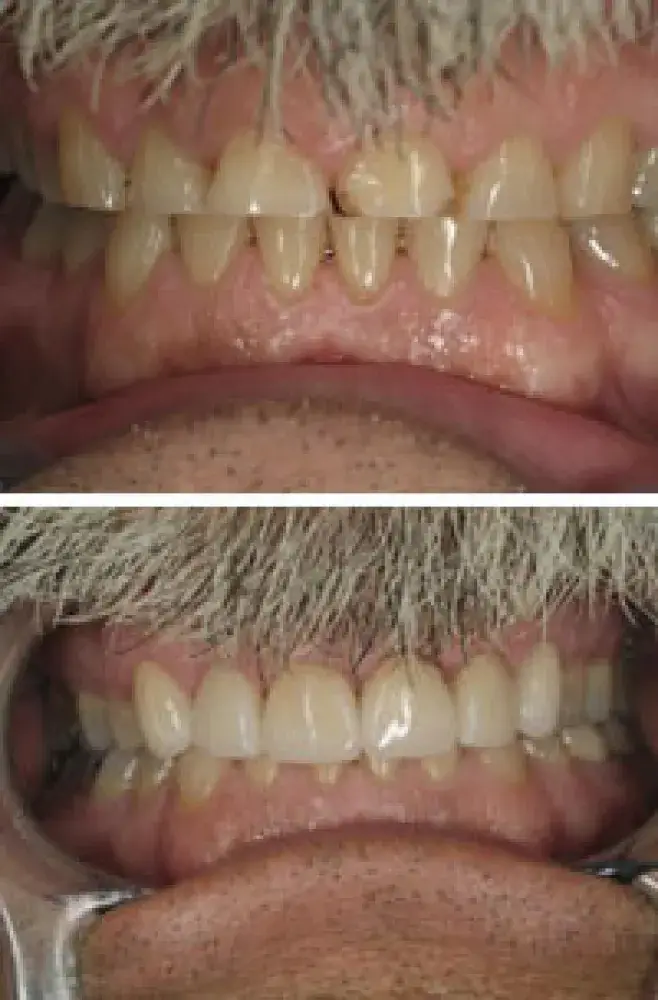 Before and After Teeth in Hayward, CA