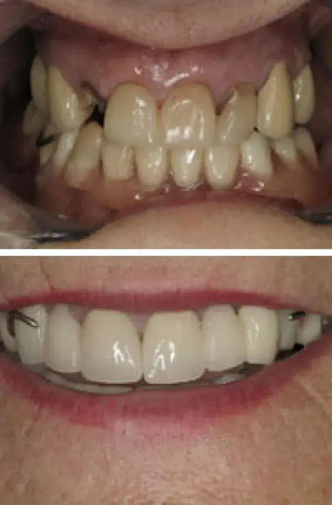Before and After Teeth in Hayward, California