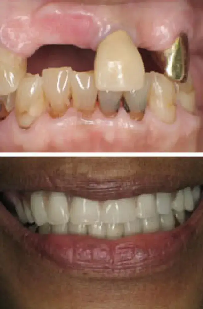 Before and After Teeth in Hayward