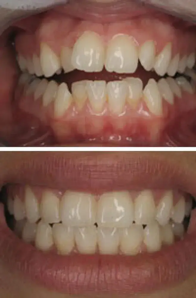 Before and After Teeth in Hayward, California