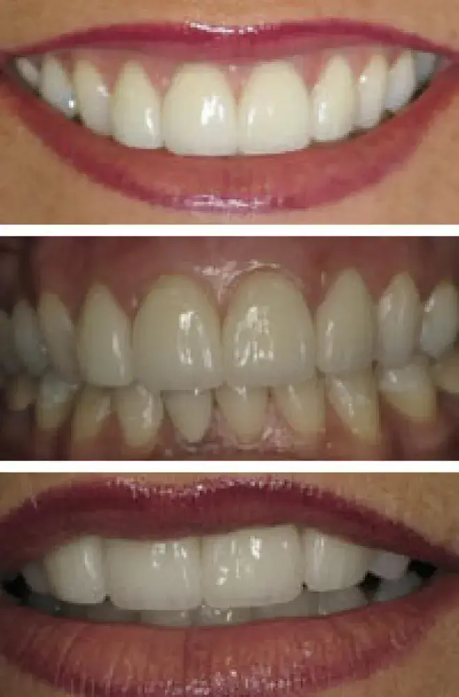 Before and After Teeth