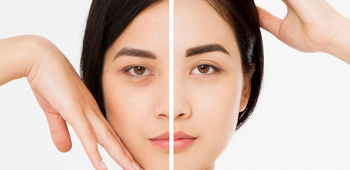 What Is a Chemical Peel